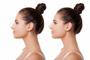 What Should You Expect from a Rhinoplasty?