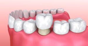 Reasons for Dental Crown to Fall Out and Preventative Measures to Take