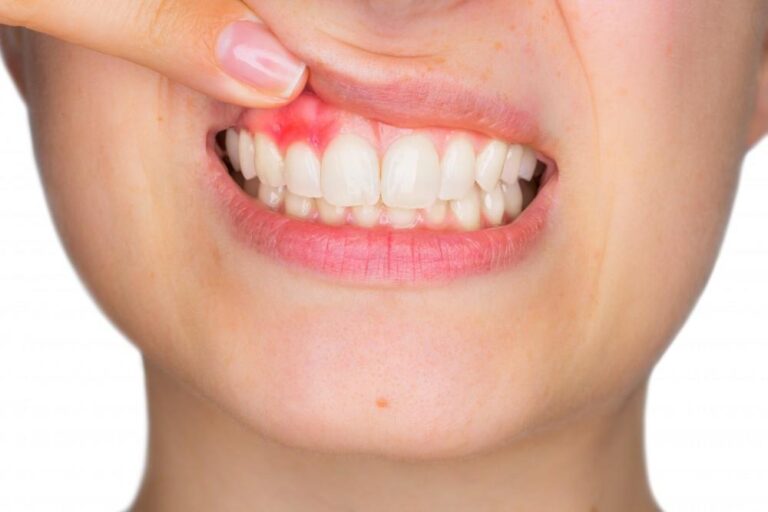 Gum Chronicles: The Signs And Symptoms Of Periodontal Disease